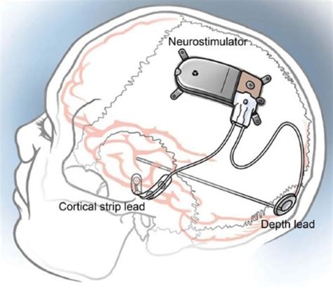 HealthWatch: RNS Implant for Epilepsy - EpilepsyU