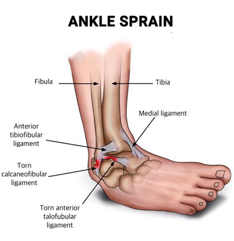 How To Cure A Sprang Ankle - Computerconcert17