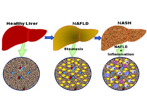 Study Identifies Target to Prevent Some Liver Cancers - NCI