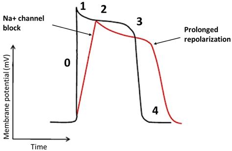 JCM | Free Full-Text | Flecainide in Ventricular Arrhythmias: From Old Myths to New Perspectives