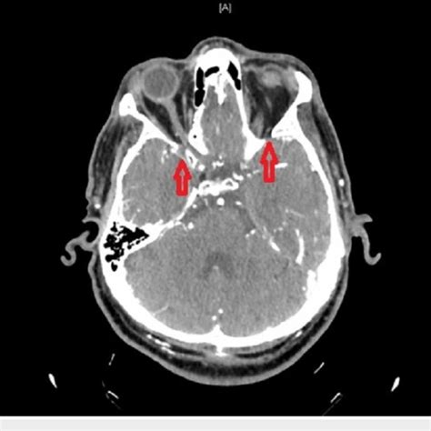 Neck and head CT angiography showed bilateral ICA occlusion ICA ...