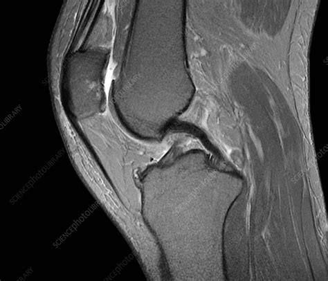 Normal knee, MRI scan - Stock Image - C026/1159 - Science Photo Library