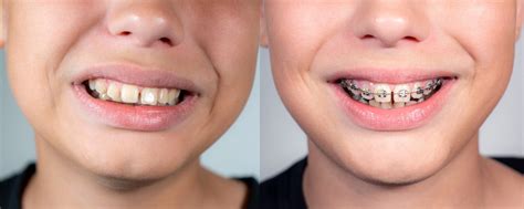 I have an overbite; what causes an overbite? - Orthodontic Society of ...