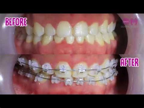 Signature Sapphire Braces by OMDC Dental Clinic - YouTube