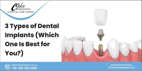 3 Types of Dental Implants: Which One Is Best for You? - Orion Dental Care