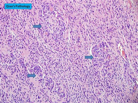 Qiao's Pathology: Glioblastoma Multiforme (GBM) | Microscopi… | Flickr