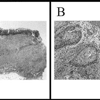 Histological analysis of small bowel (A) and omental mass (B) showing ...