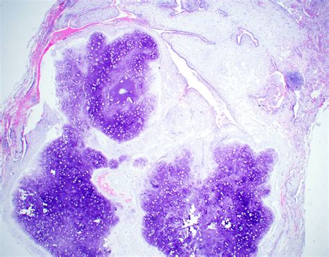 Pathology Outlines - Pulmonary hamartoma