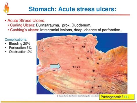 Curling Ulcer - Duodenal ulcer - symptoms, causes, diagnosis, Duodenal ... / A curling's ulcer ...