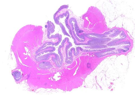 Diverticulosis | Encyclopedia MDPI