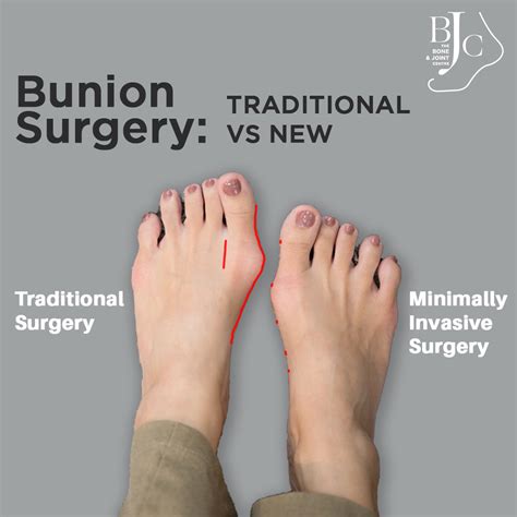 Bunion Surgeon | Minimally Invasive Bunion Surgery | The Bone & Joint ...