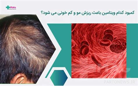 Which vitamin deficiency causes hair loss and anemia? | پرتو نیوز