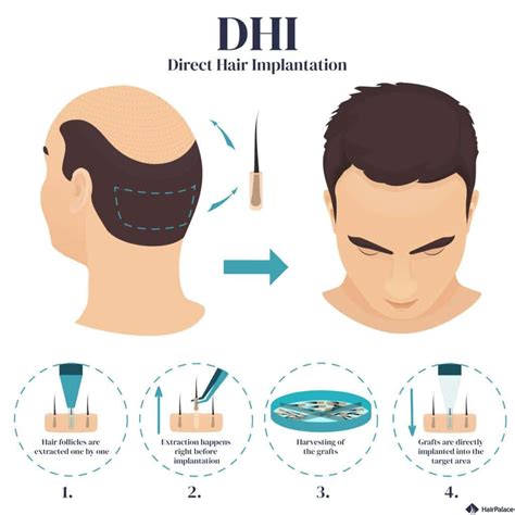 DHI Hair Transplant: Procedure, Costs & Results