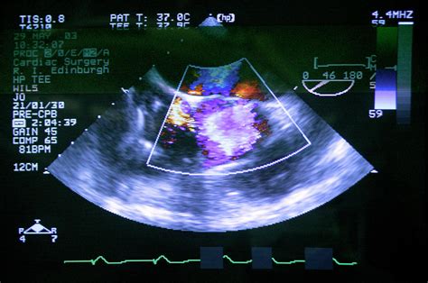 Damaged Aortic Valve Photograph by Antonia Reeve/science Photo Library ...