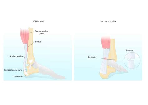 Achilles Tendon Lengthening (Surgery) | Pediatric Foot & Ankle