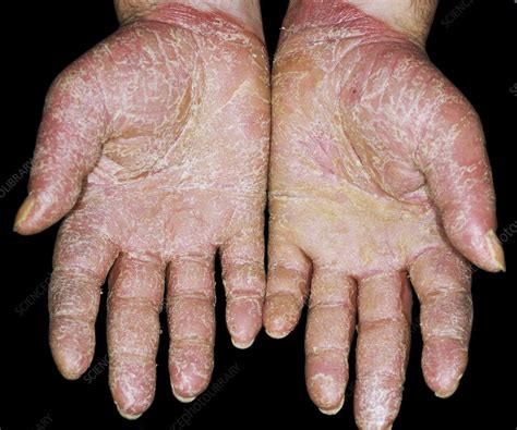 Psoriasis on the palms of the hands - Stock Image - C014/2544 - Science ...