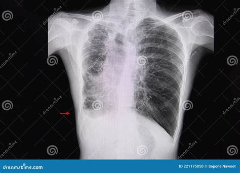 Bronchiectasis Chest X Ray