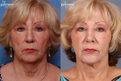 Facelift Before and After Pictures Case 118 | Orlando, Florida ...