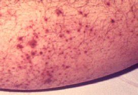 Petechiae - Pictures, Causes, Diagnosis, Treatment and Cure