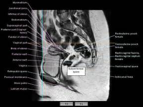 MRI of the female pelvis