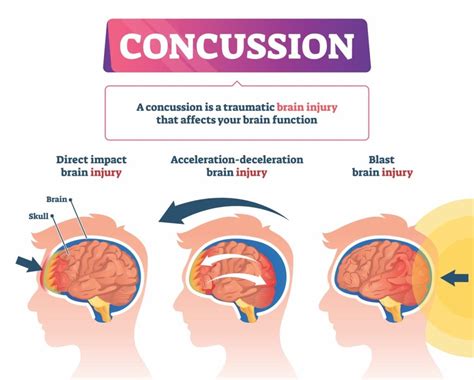 뇌진탕(Concussion of the brain)🧠 : 네이버 블로그