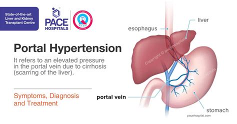 Portal Hypertension Usmle Step Etiology Clinical Features | My XXX Hot Girl