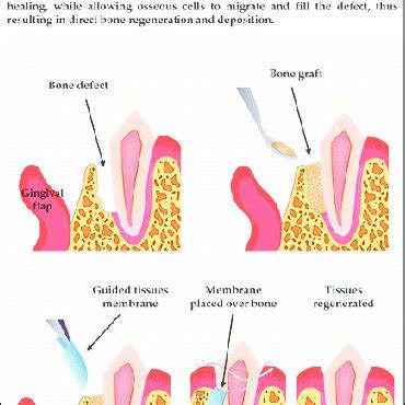 1 Illustration showing periodontal guided tissue regeneration (GTR ...