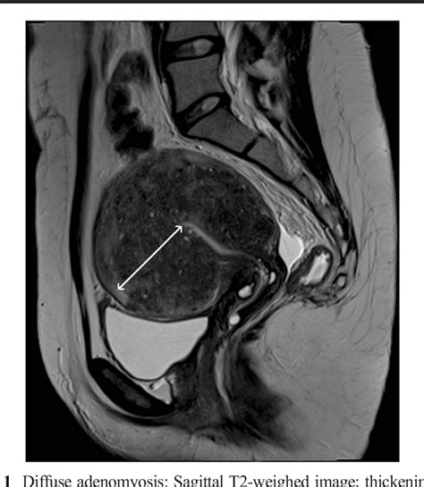 [PDF] MRI for adenomyosis: a pictorial review | Semantic Scholar