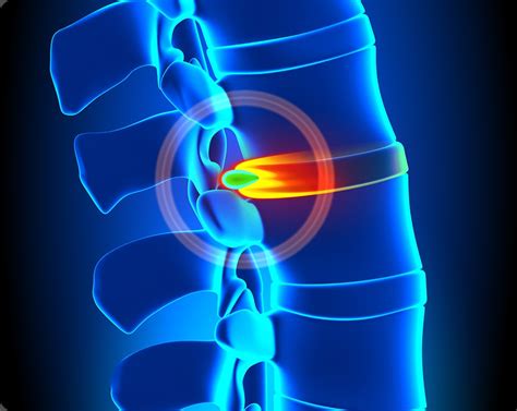 Herniated Disc Adjustment | Max Physiotherapy | NE Calgary