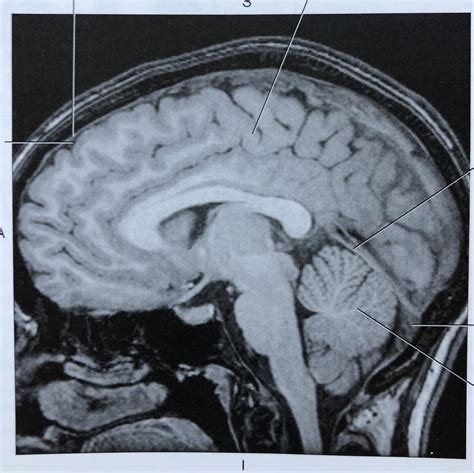 Sagittal T1 MRI Tentorium Cerebelli Diagram | Quizlet