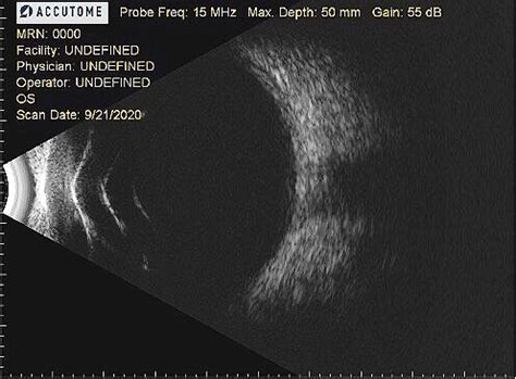 B-Scan Ultrasonography Chicago | University Retina