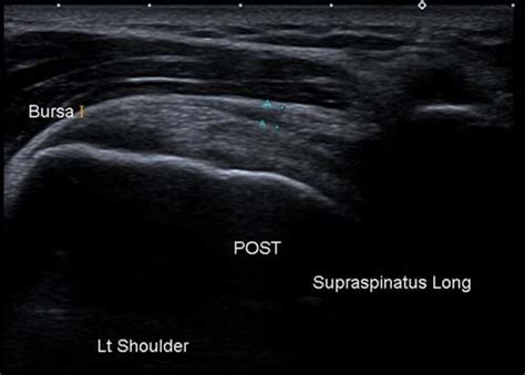 Subdeltoid Bursitis Ultrasound