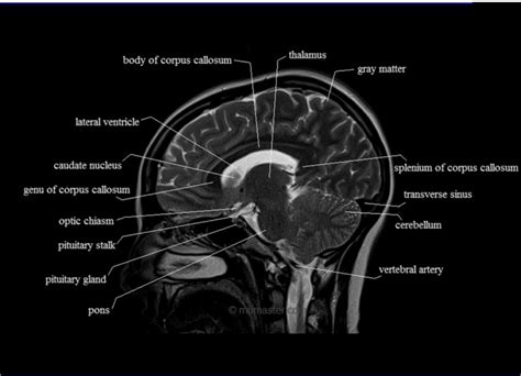 Brain Lobes Labeled Mri at Harold Cook blog