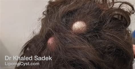 scalp lump - LipomaCyst.com | Cyst and Lipoma Specialists