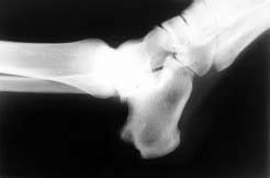 Calcaneal enthesopathy. Lateral radiographic view of the right ankle in ...