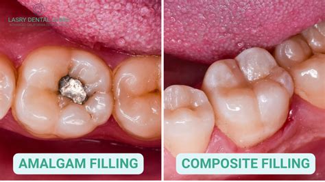 Do You Have a Cavity? Cavities Stages & What They Look Like