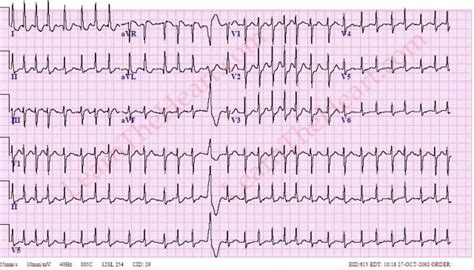 Dilt v. Metoprolol in Afib/RVR