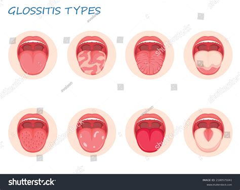 Atrophic Glossitis