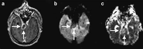 46-year-old man with a ring-enhancing pontine mass lesion biopsy proven... | Download Scientific ...