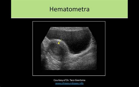 hematometra