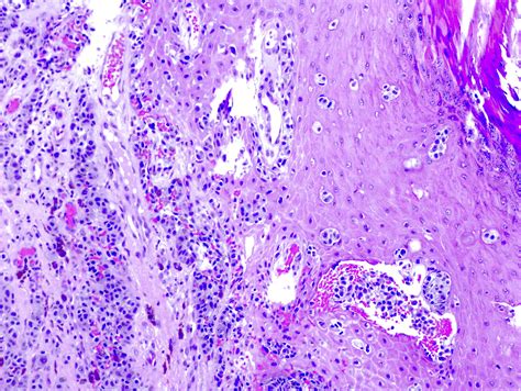 Acral Lentiginous Melanoma Histology