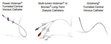 What are tunneled catheters? What are their types?