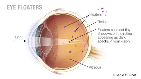 Eye Floaters: What are they and when should you be concerned?