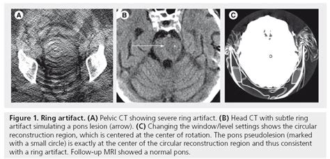 CT artifacts: causes and reduction techniques