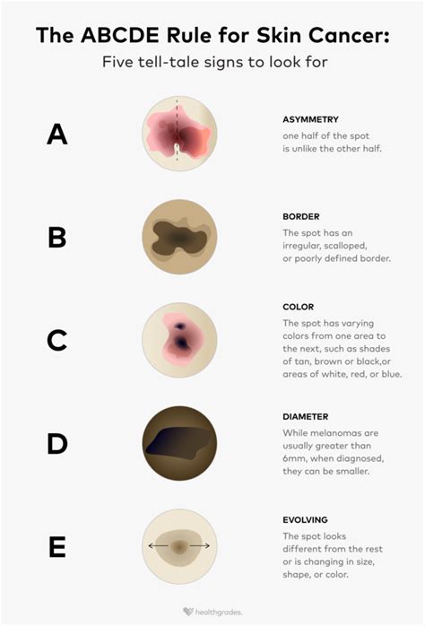 ABCDEs of Skin Cancer: Melanoma Symptoms