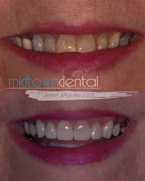 Dental Crowns Before & After Photos - Midtown Dental - Sacramento, CA