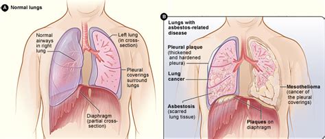 What is Pleural Plaque and Diffuse Pleural thickening? – Action on Asbestos: Industrial Injury ...