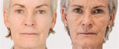 Can Botox Help Reduce Sagging Jowls?