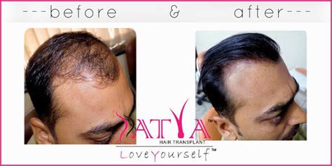 Satya Skin And Hair Transplantation: How to look smart with Biofibre ...