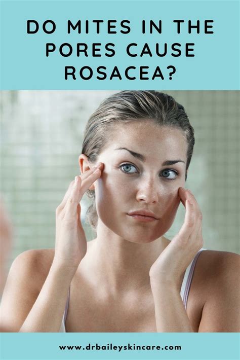 Do Mites in the Pores Cause Rosacea? in 2021 | Rosacea, What is rosacea, Demodex mites